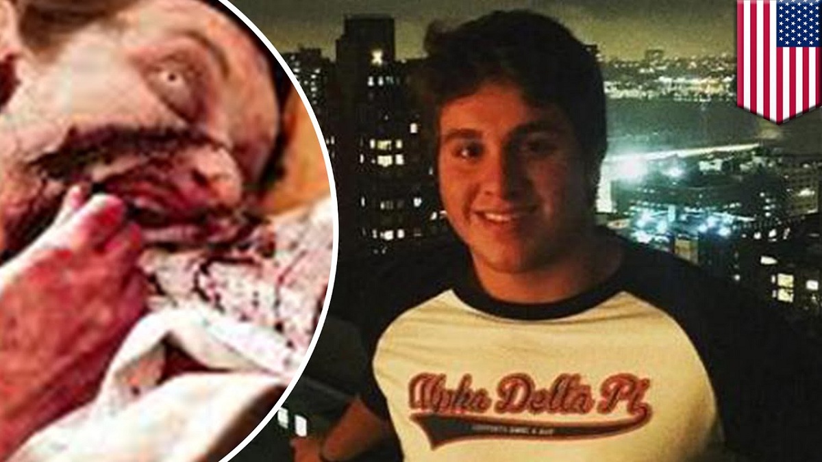 АНУ-ын Флоридад 2016 онд флакка хэрэглэсэн залуу хүн рүү дайрч нүүрийг нь идсэн хэрэг гарч байв.